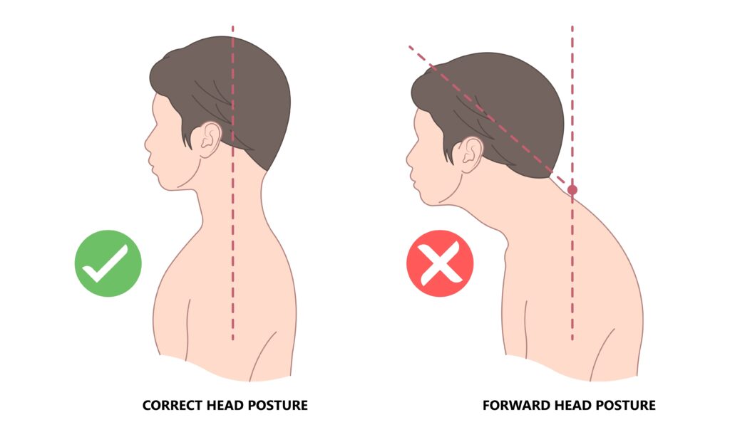 Illustration of man showing correct head posture and poor posture